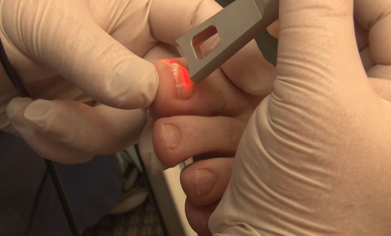 Foot & Ankle Ulcer Care, Treatment of Plantar Warts, Foot Care Services in canada,