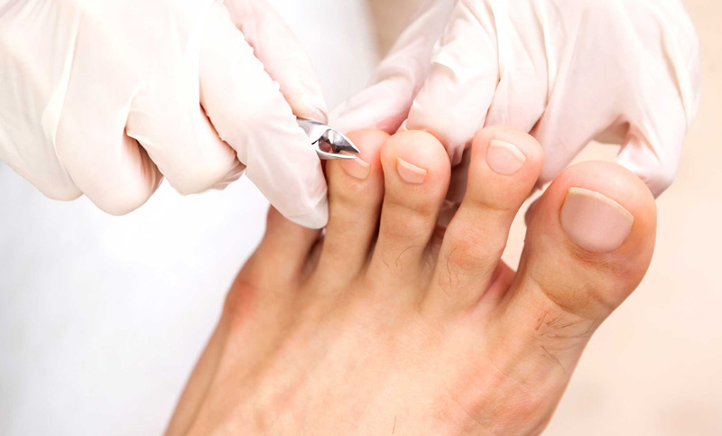 Athletes Foot, Dry Skin, Eczema,